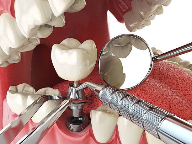 Best Emergency Root Canal Treatment in Forest Acres, SC